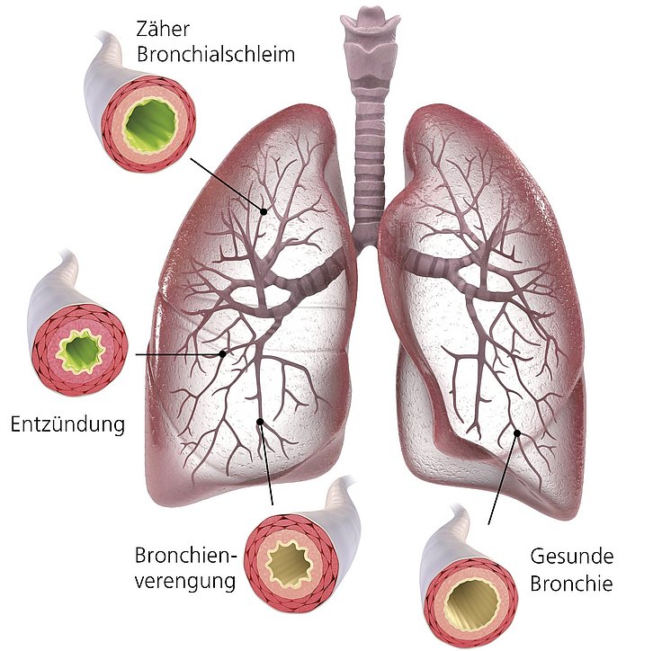 Hier sieht man die Atemwege der Lunge. Bei einem Husten sind diese oft verschleimt. © c_3drenderings / fotolia.de